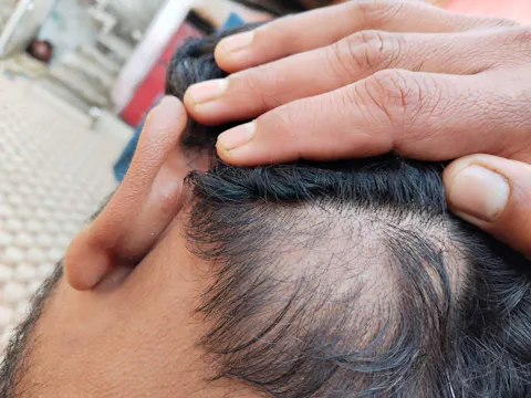 Advanced Ayurvedic Formula for Alopecia Treatment | Doctor Recommended | 100% Safe & Effective