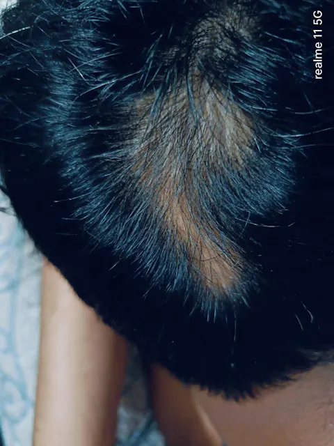 Advanced Ayurvedic Formula for Alopecia Treatment | Doctor Recommended | 100% Safe & Effective
