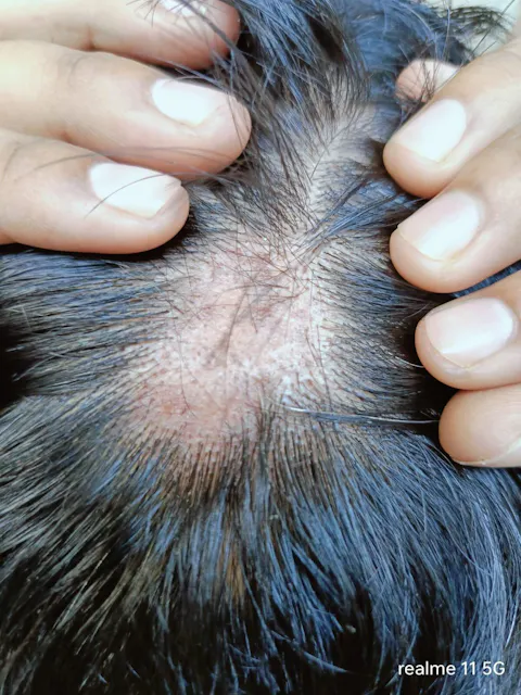 Advanced Ayurvedic Formula for Alopecia Treatment | Doctor Recommended | 100% Safe & Effective