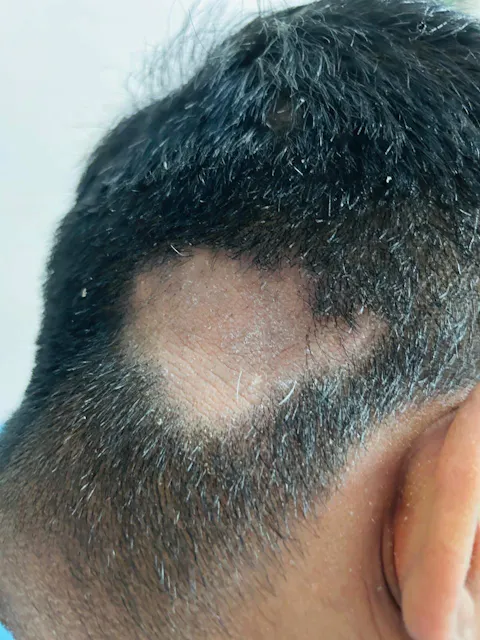Advanced Ayurvedic Formula for Alopecia Treatment | Doctor Recommended | 100% Safe & Effective
