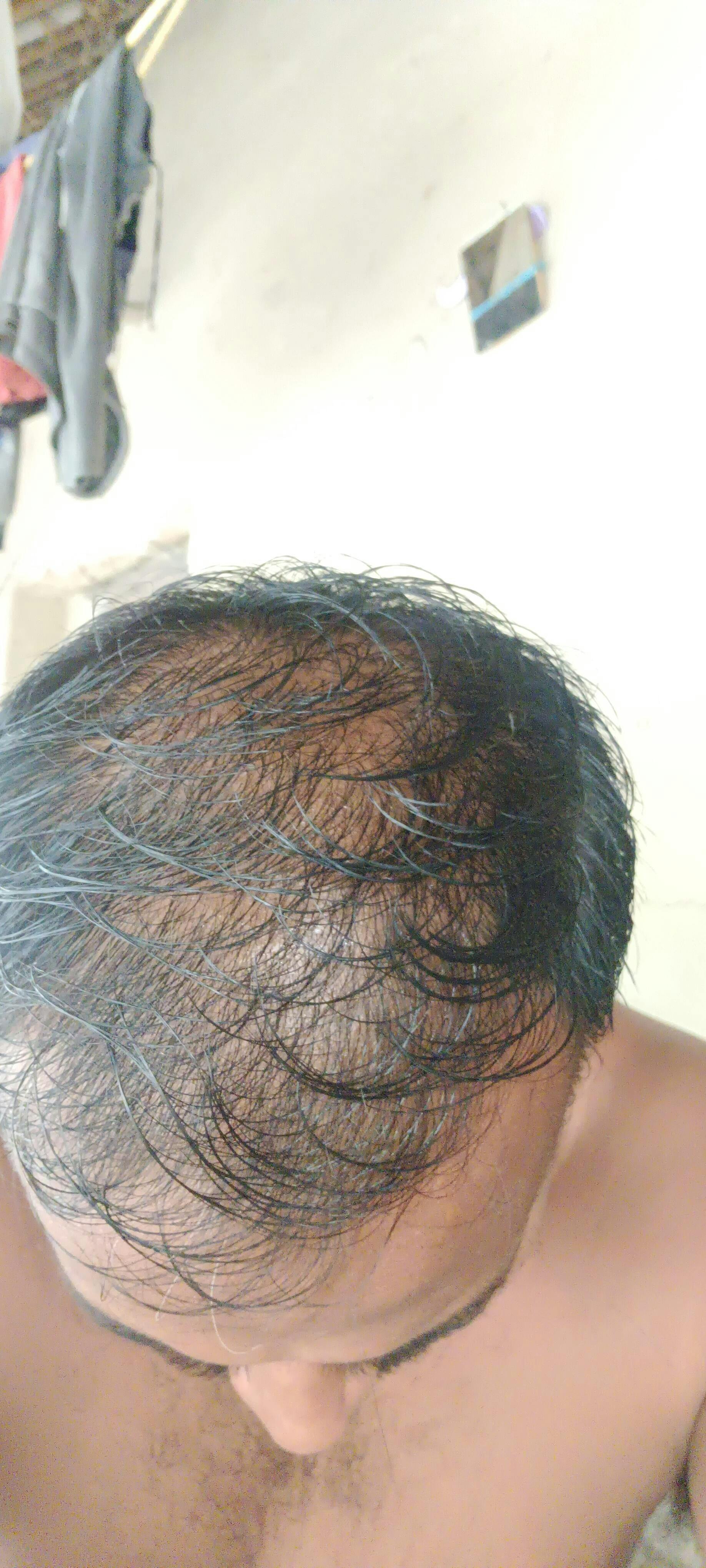 Baldness Say goodbye to baldness New lowcost tech can reactivate hair  production  The Economic Times