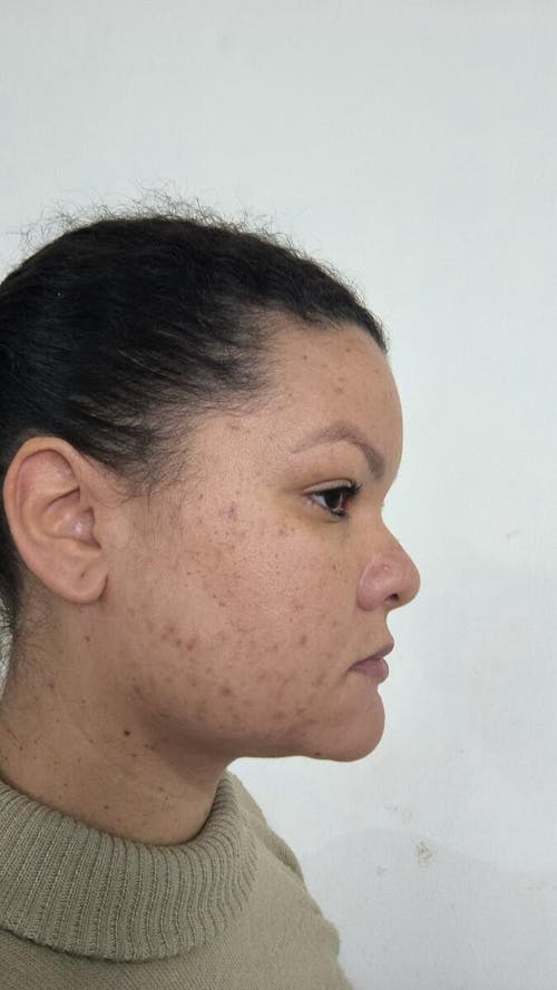 Solução S-Control | Sérum Corretor de Acne