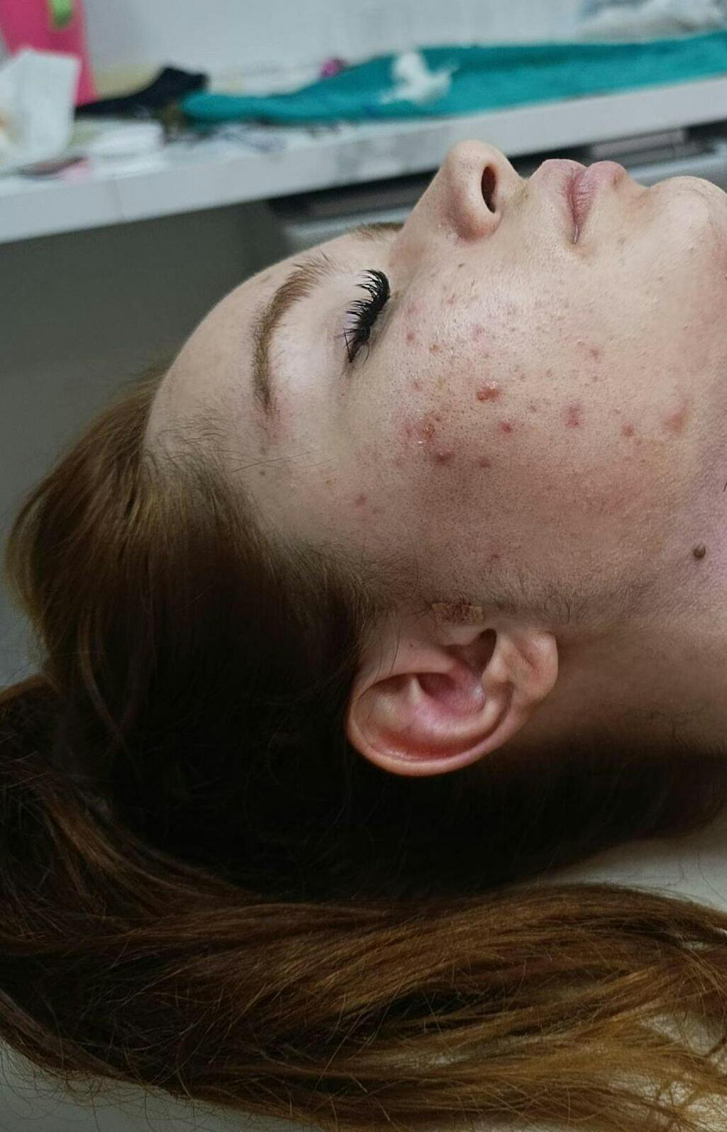 Solução S-Control | Sérum Corretor de Acne