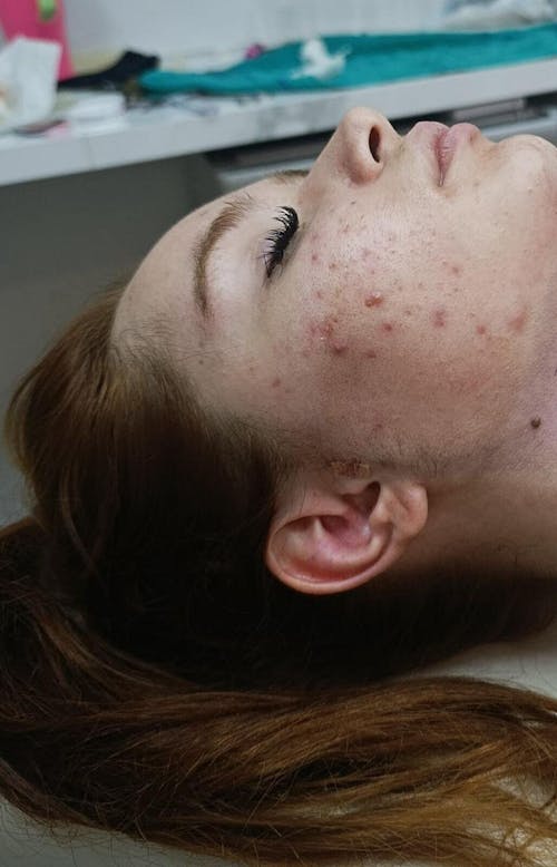 Solução S-Control | Sérum Corretor de Acne