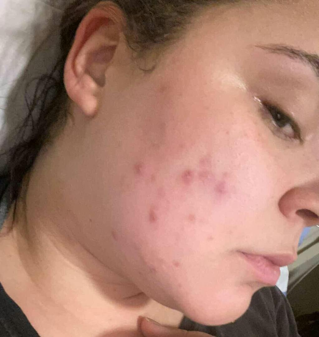 Solução S-Control | Sérum Corretor de Acne