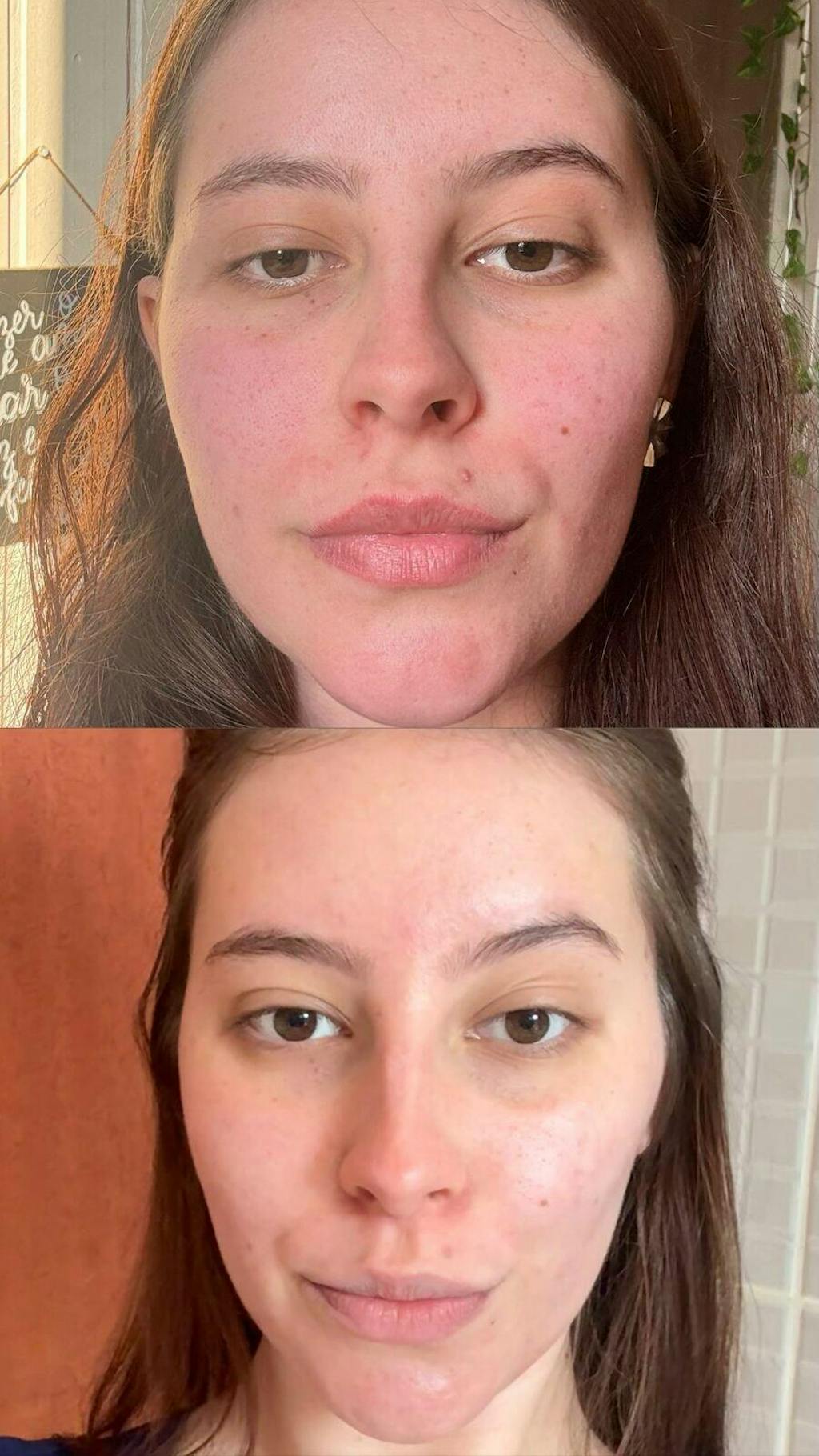 Solução S-Control | Sérum Corretor de Acne