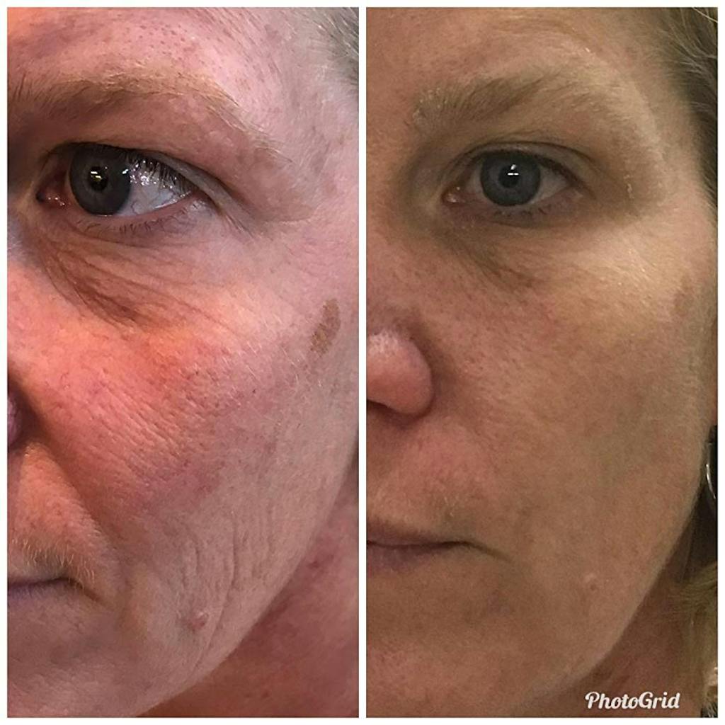 RED LED+ AntiAging Light Therapy