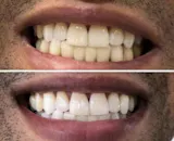 Pure Glow PAP Teeth Whitening Strips with Hydroxyapatite – 28 Strips (14 Day Treatment)