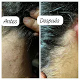 Kit Control Caspa, Grasa y Dermatitis Seborreica