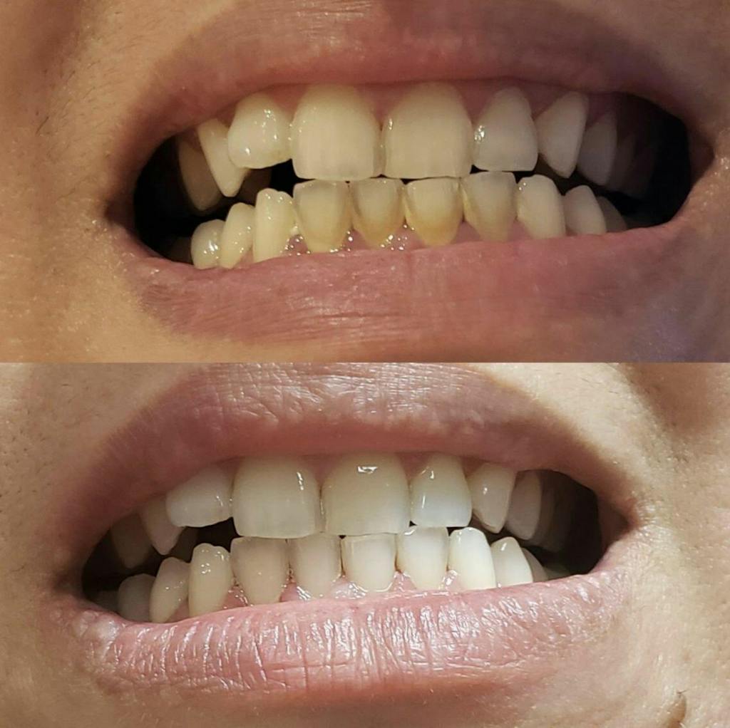 SmileFresh™ Ultrasonic Tooth Cleaning Wand