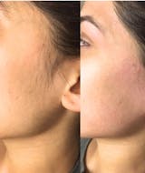 Removely IPL 3+ for men