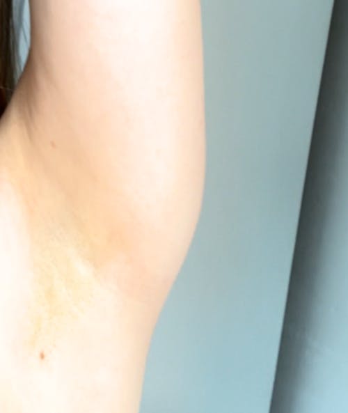 Removely IPL 3+   (inkl. Summer Sale Geschenk)