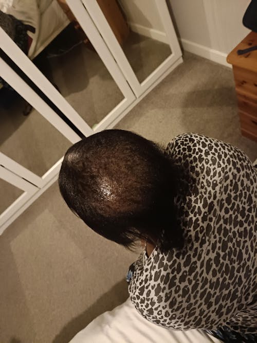 Alopecia + Thinning Hair Solutions - The Harvest Hair Growth Kit