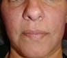 RosaLight™ - The Rosacea Phototherapy Mask