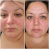 RosaLight™ - The Rosacea Phototherapy Mask
