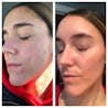 RosaLight™ - The Rosacea Phototherapy Mask
