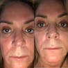 RosaLight™ - The Rosacea Phototherapy Mask