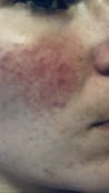 RosaLight™ - The Rosacea Phototherapy Mask