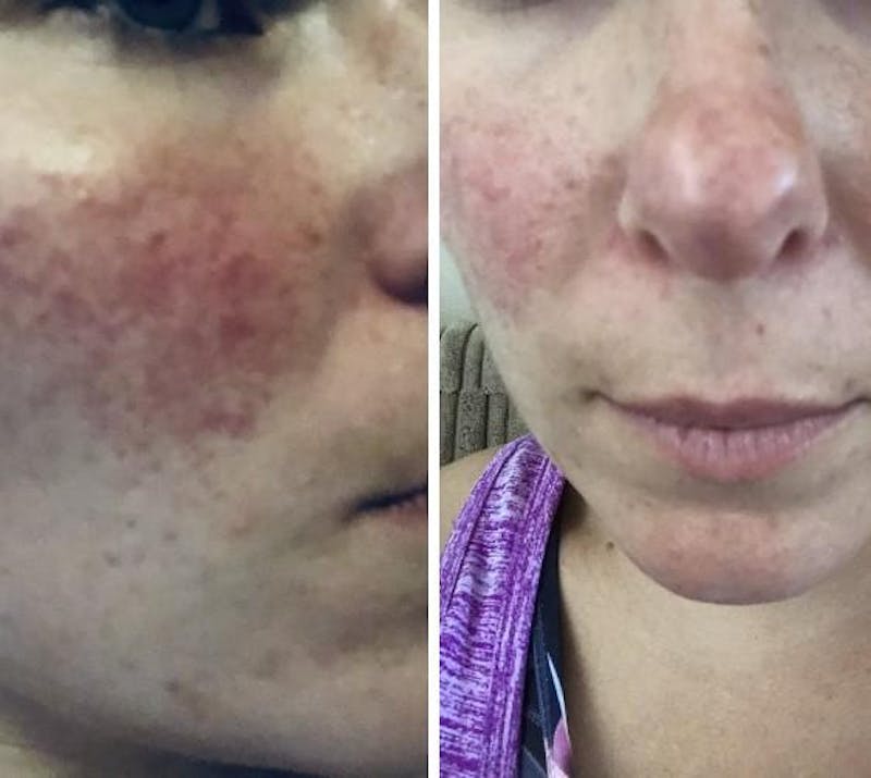 RosaLight™ Rosacea LED Light Therapy Mask Natural & Effective