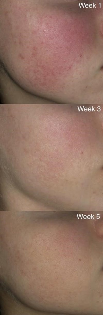 RosaLight™ - The Rosacea Phototherapy Mask