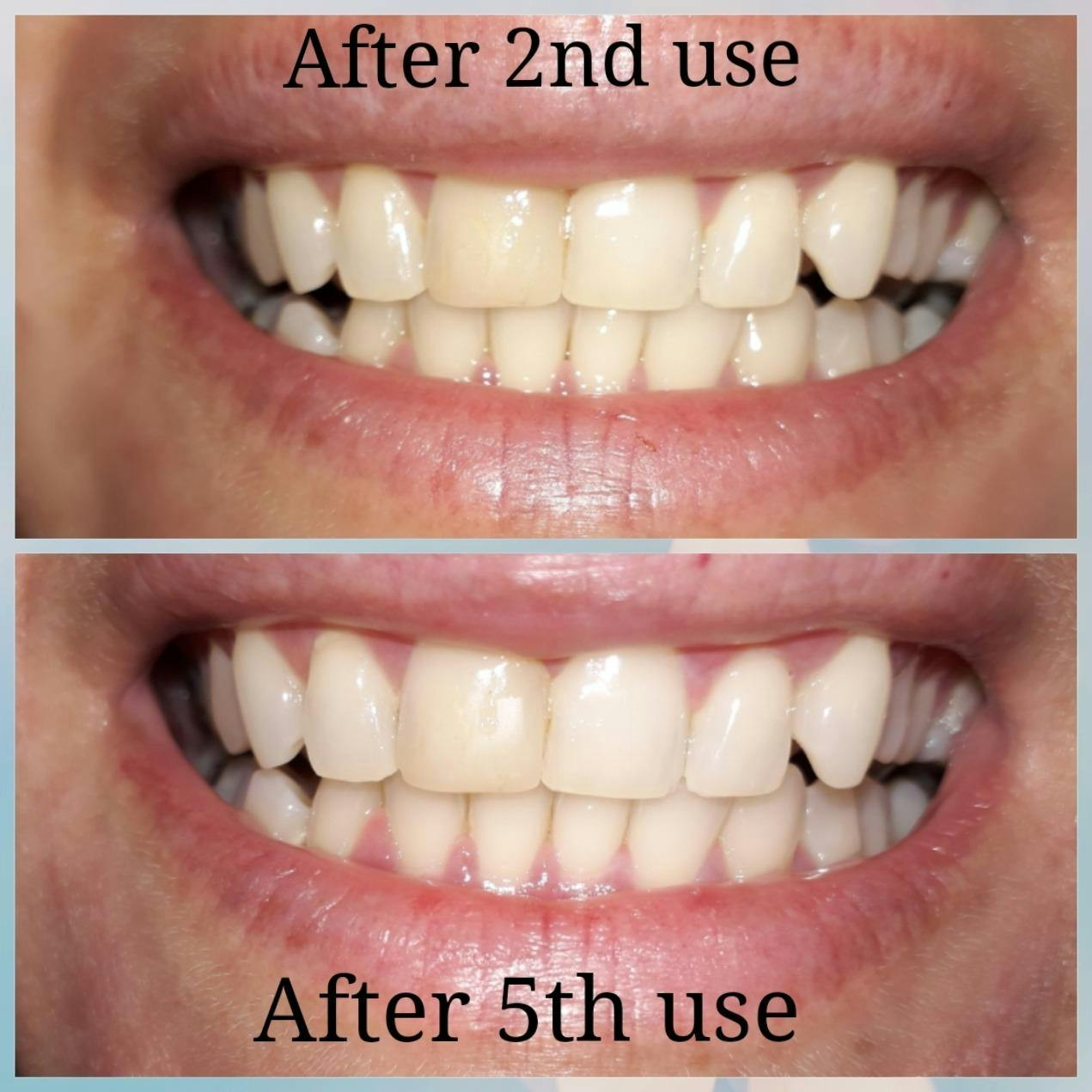 crest white strips gentle before and after