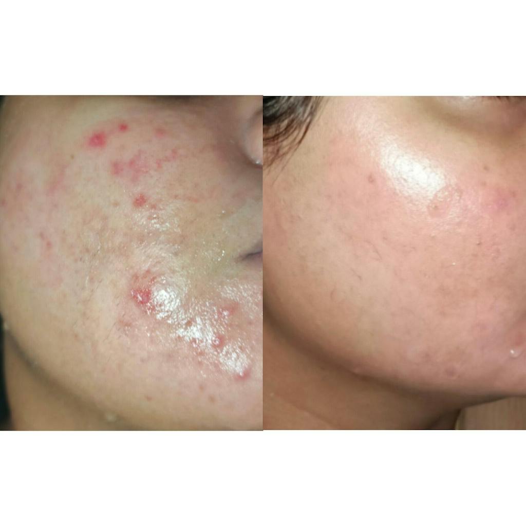 Salicylic Acid 2% Gel Cleanser