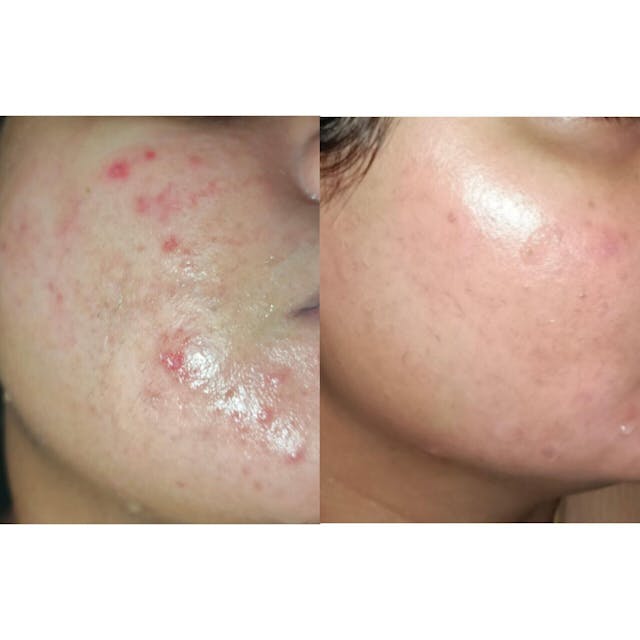 Salicylic Acid 2% Gel Foaming Cleanser