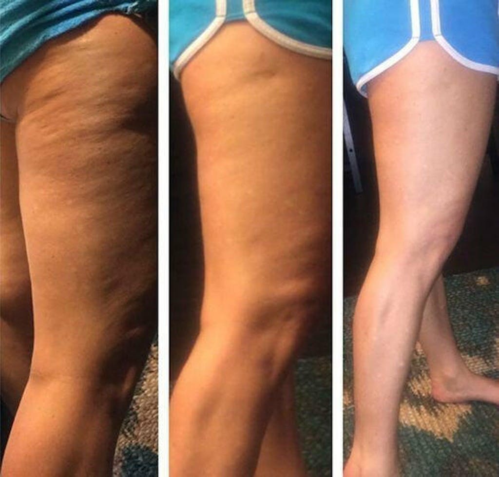 UltraCavitat Cellulite & Fat Treatment Machine US UltraCavitat™