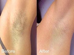 laser hair removal reviews