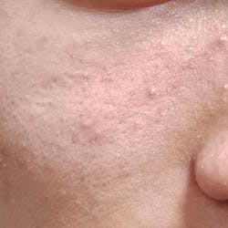 Azulene Spot Control Quota Pad