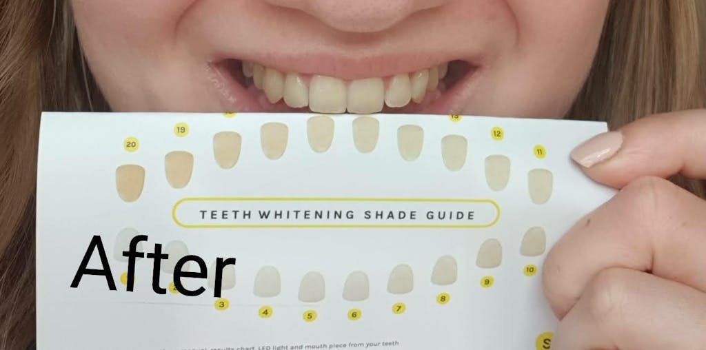 Teeth Whitening Kit Voted 1 UK 2023 SmileTime