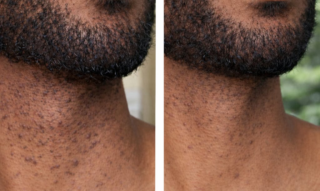 Marre des taches qui restent des semaines sur votre peau ?