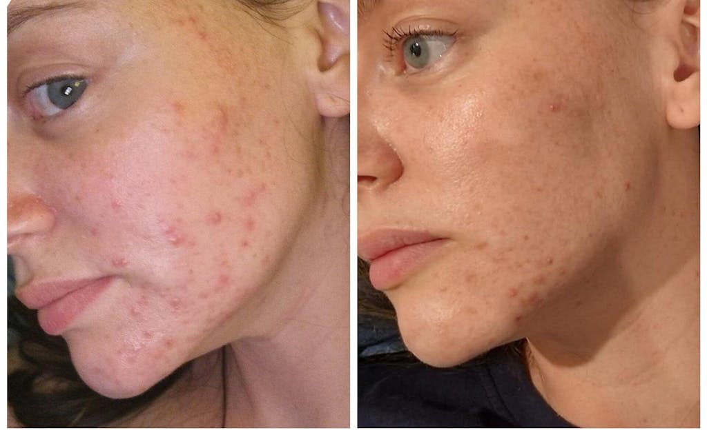 The Stratum Clear Skin Bundle