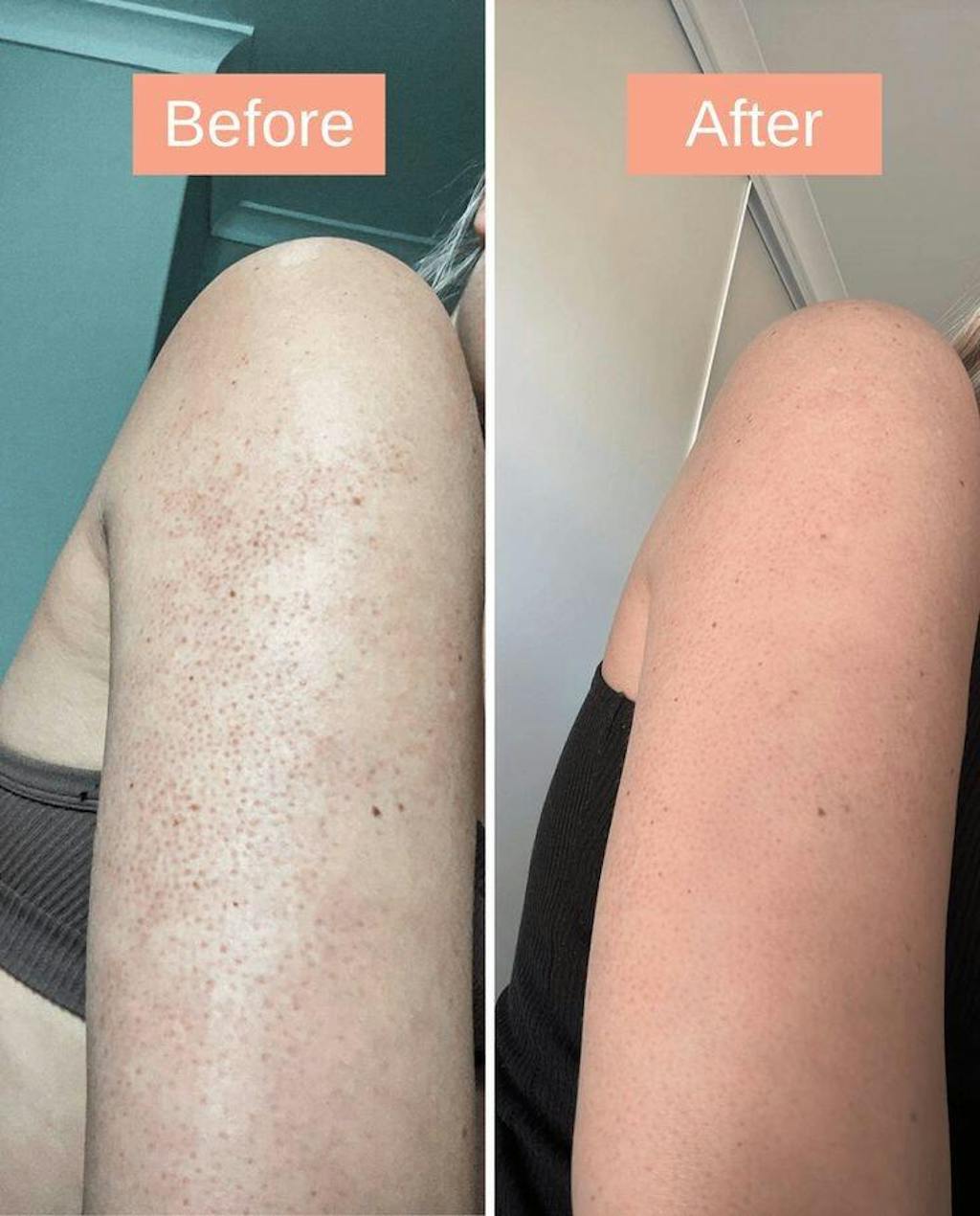 Advanced Triple-Acid Complex for Keratosis Pilaris – Strawberry