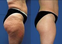 CelluVac Pro™ - Behandling av celluliter och bristningar