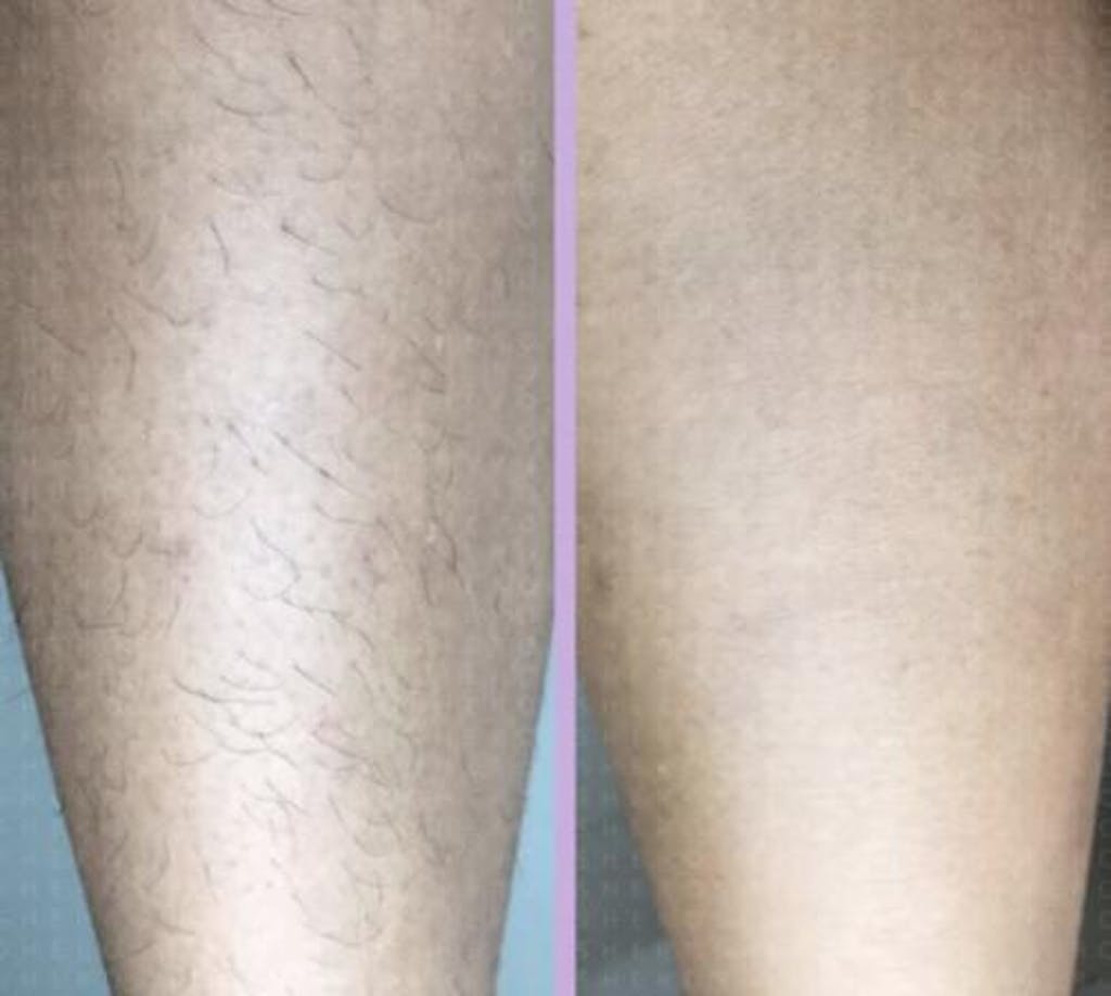LUX SKINS® - #1 in Permanent Hair Removal – The Lux Skins