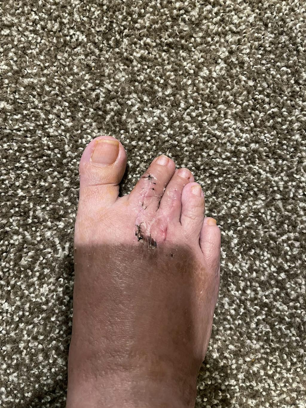 Injinji Performance Toe Socks Athletic Toe Socks The Natural Athletes Clinic