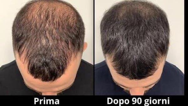 REVITA - LOZIONE RISCRESCITA E ANTICADUTA