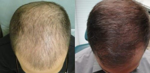 REVITA - LOZIONE RISCRESCITA E ANTICADUTA