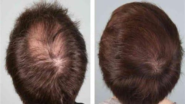 REVITA - LOZIONE RISCRESCITA E ANTICADUTA