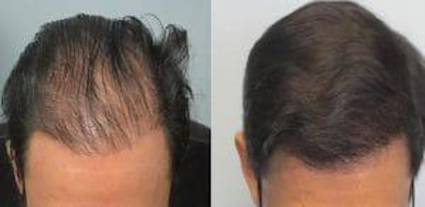 REVITA - LOZIONE RISCRESCITA E ANTICADUTA