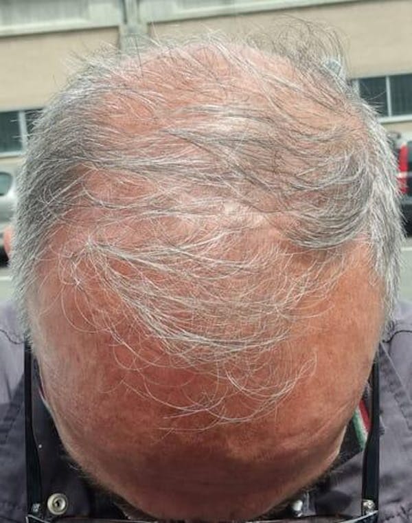 REVITA - LOZIONE RISCRESCITA E ANTICADUTA