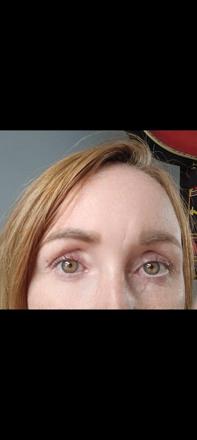 Before & After Photos – UKLASH