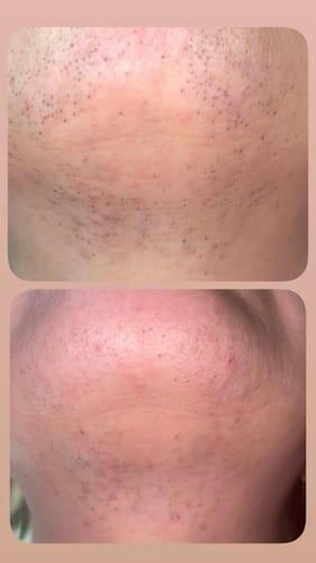 Ulike Air 10 (Subscriber Exclusive Offer)