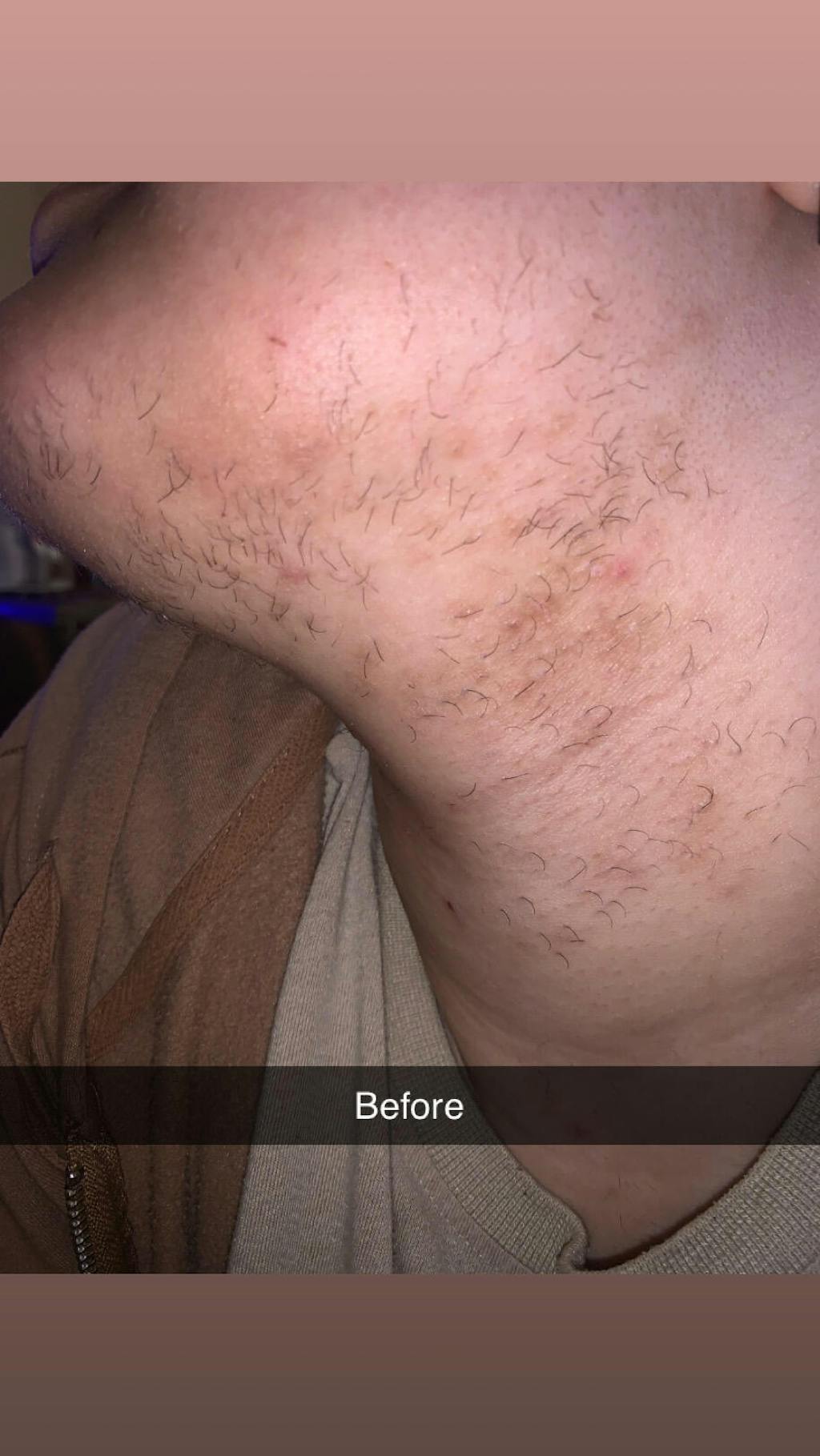 Umber By J Lenay | Reducing Excessive Hair Naturally