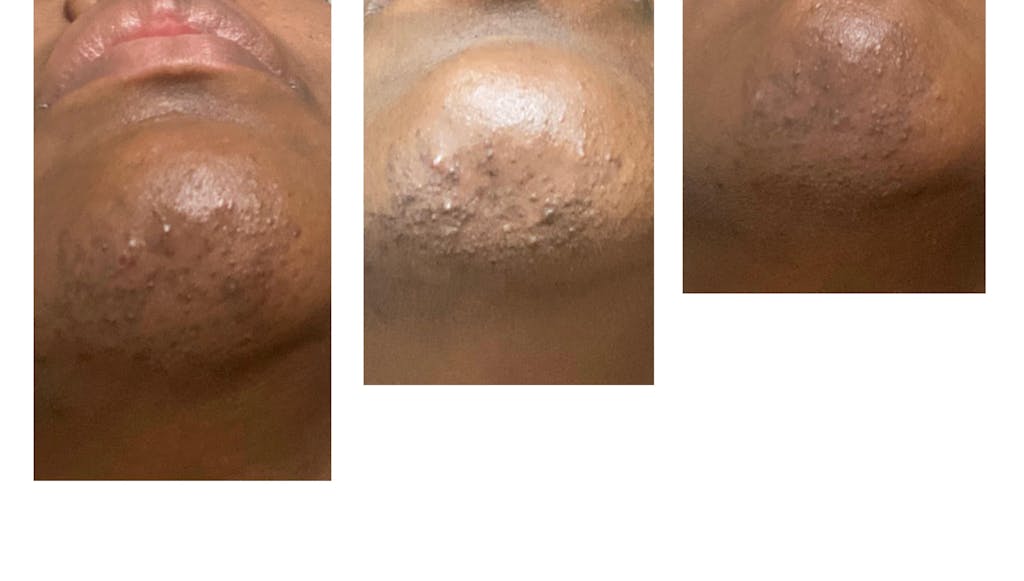 Facial Moisturizer (Ingrown Hair/Acne)