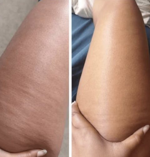 VIBRAPRO - Appareil Anti-Cellulite & Brûle-Graisse