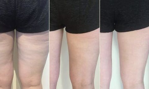 VIBRAPRO - Appareil Anti-Cellulite & Brûle-Graisse