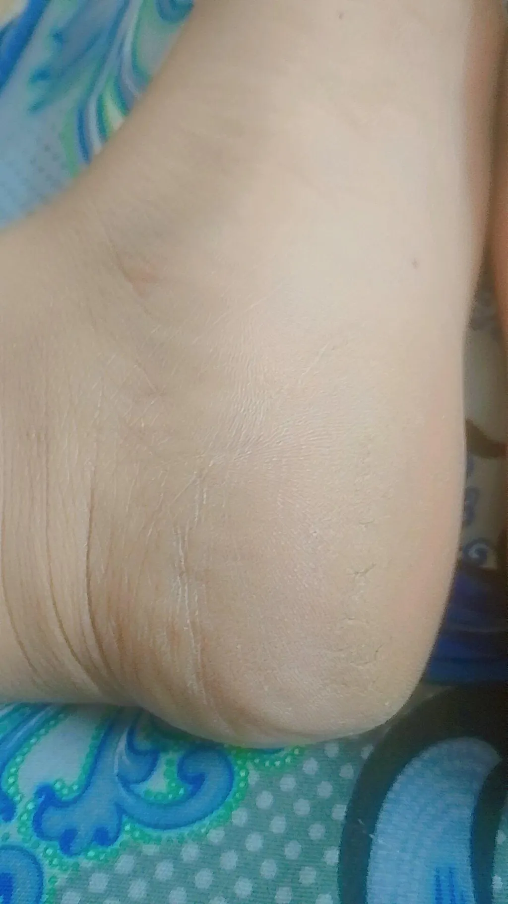 CRACKLESS Heel Care