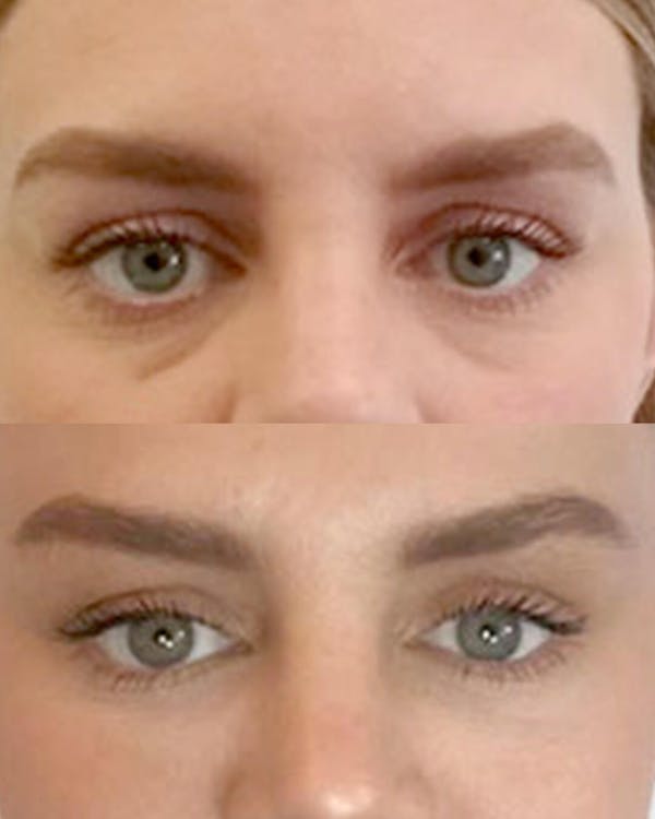 ISA ✨ VARITA MAGIC LED FACIAL